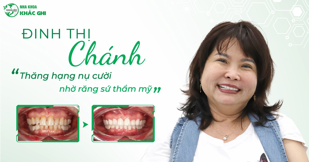 Việt kiều Pháp cười hạnh phúc với răng sứ Zirconia - Đinh Thị Chánh 1 khach hang rang su kich thuoc lon