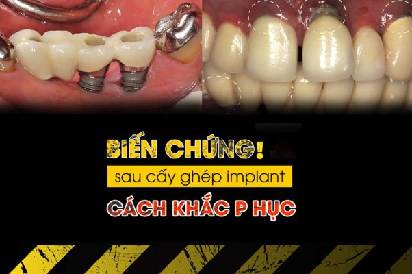 cac bien chung khi cam implant co the xay ra va cach khac phuc 7405