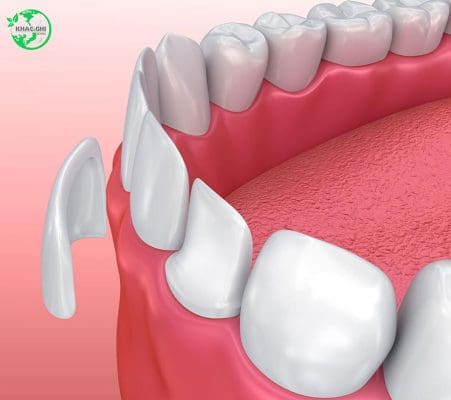 dan su veneer la gi uu diem quy trinh bang gia chi tiet 9284