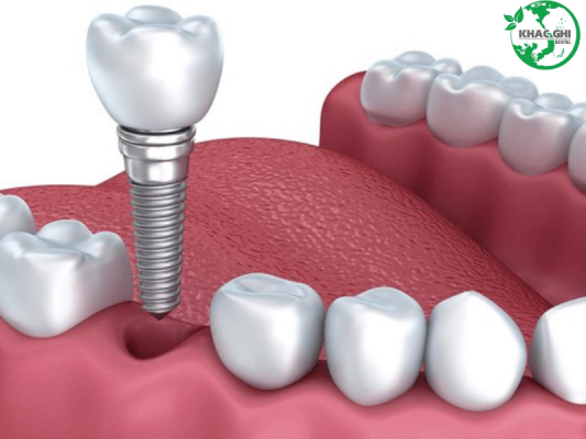 dich vu trong rang implant bien hoa 7186