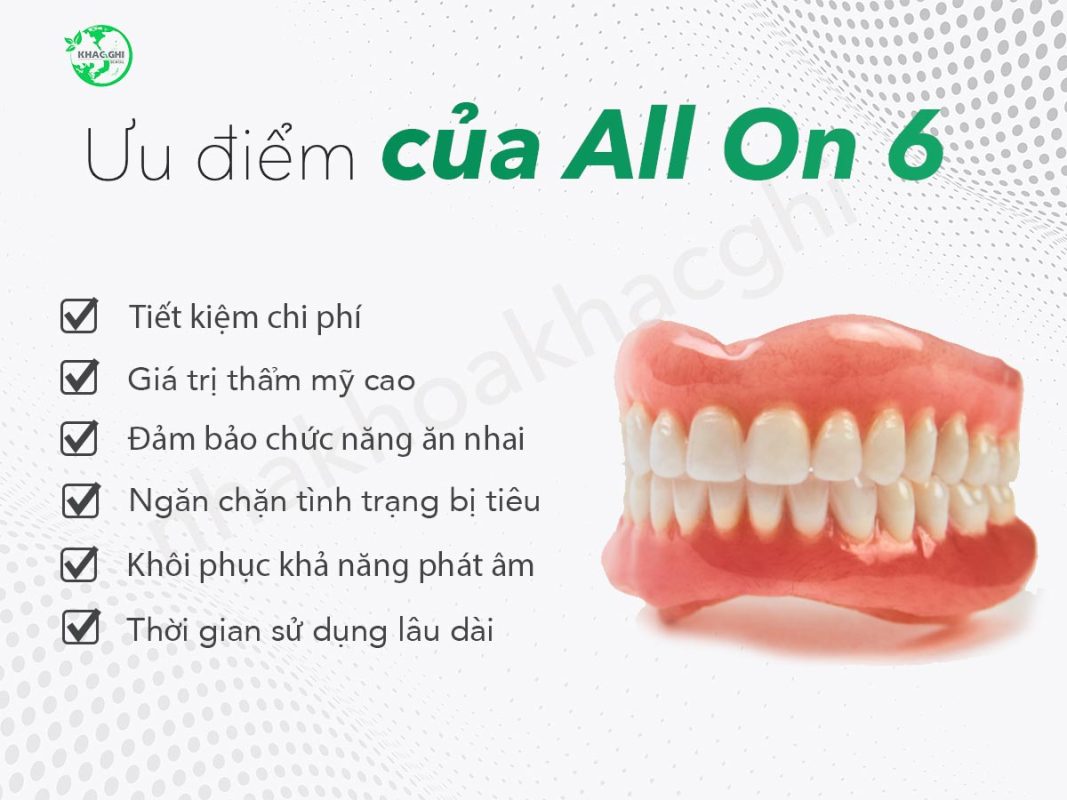 ky thuat trong rang implant all on 6 4204