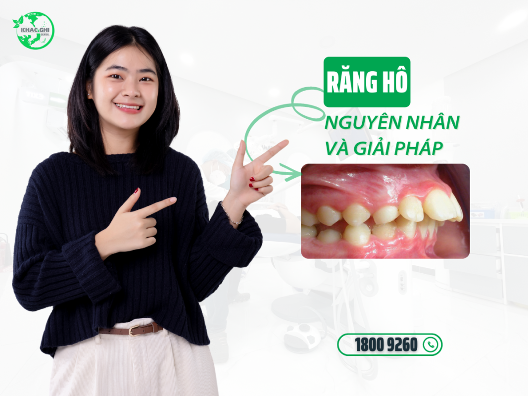 Răng Hô: Nguyên Nhân, Các Kiểu Hô & 3 Cách Khắc Phục Hiệu Quả 8 nhung bat loi cua rang ho va phuong phap khac phuc 1
