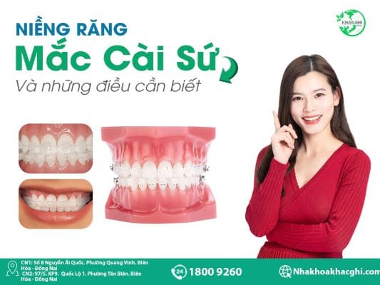 nieng rang mac cai su va nhung dieu can biet nha khoa khac ghi 1797