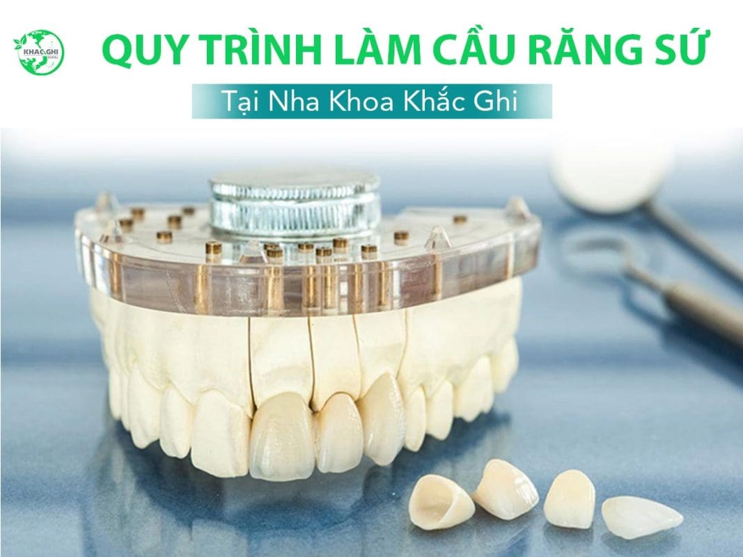 Quy Trình Làm Cầu Răng Sứ Chi Tiết Qua 5 Bước Chuẩn Y Khoa 7 quy trinh lam cau rang su 5 buoc chuan 6406