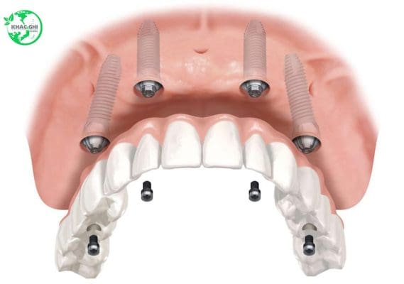 trong rang implant all on 4 gia bao nhieu 1436
