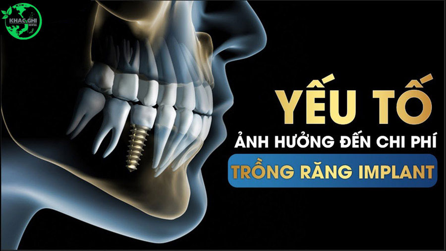trong rang implant gia bao nhieu 8602