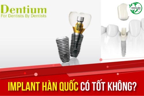 trong rang implant han quoc co tot khong 9291