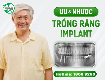 uu nhuoc diem trong rang implant 8405