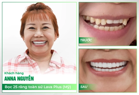 KHACH HANG SU TRUOC SAU ANNA NGUYEN