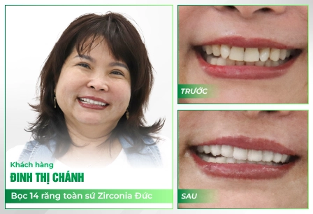 KHACH HANG SU TRUOC SAU DINH THI CHANH 01