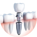 buoc bon trong implant