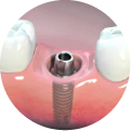 buoc hai trong implant