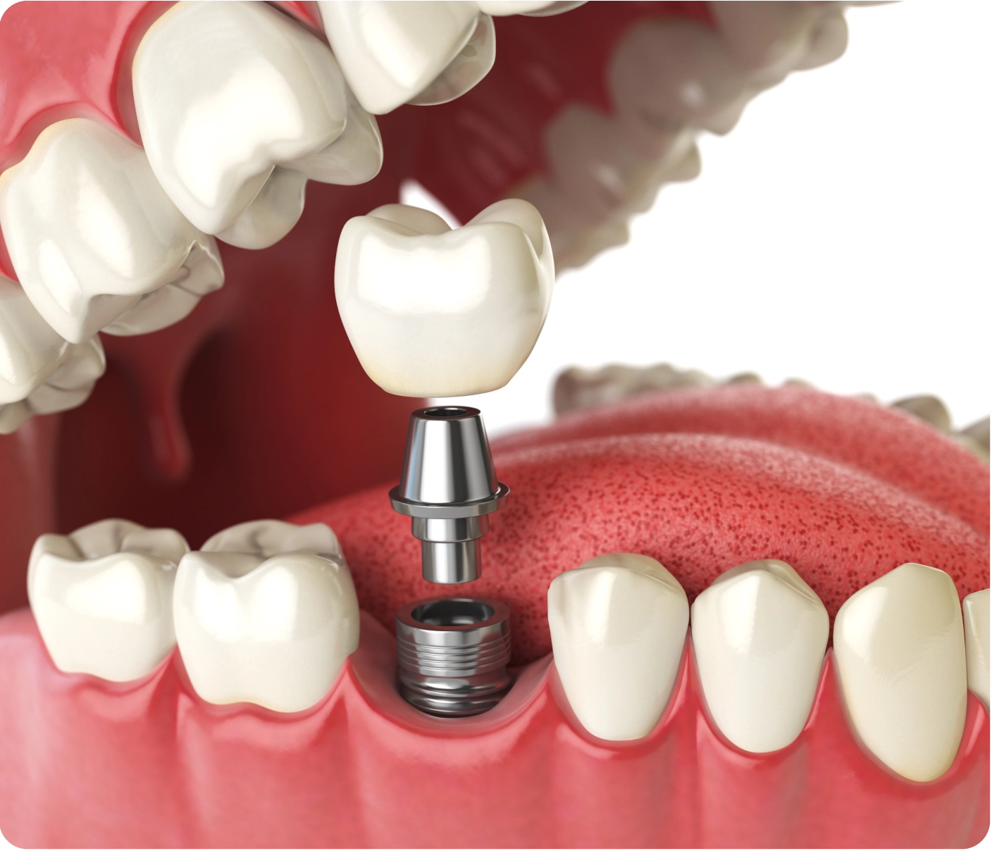implant don le la gi 01