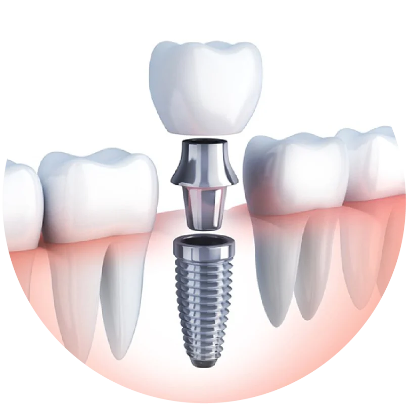 loi ich cua trong rang implant don le