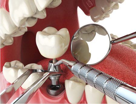 tai sao nen trong rang implant
