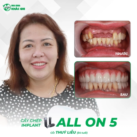 tinh trang truoc va sau khach so bon