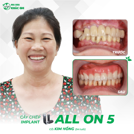 tinh trang truoc va sau khach so hai