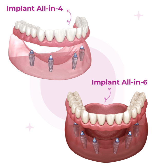 trong rang implant toan ham all on x