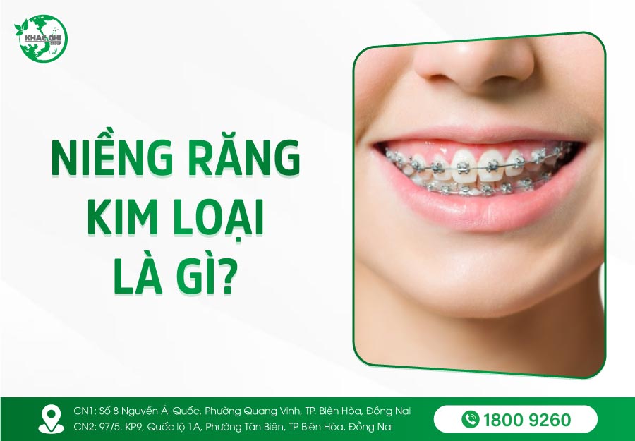 Niềng răng mắc cài kim loại là gì ? Quy trình, Phân loại, Bảng giá 13 nieng rang mac cai kim loai la gi quy trinh phan loai bang gia 1