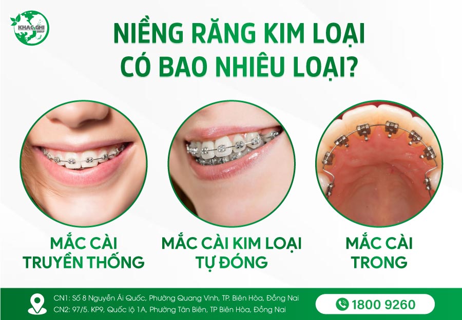 Niềng răng mắc cài kim loại là gì ? Quy trình, Phân loại, Bảng giá 14 nieng rang mac cai kim loai la gi quy trinh phan loai bang gia 2