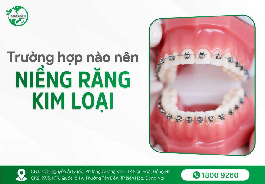 Niềng răng mắc cài kim loại là gì ? Quy trình, Phân loại, Bảng giá 16 nieng rang mac cai kim loai la gi quy trinh phan loai bang gia 4