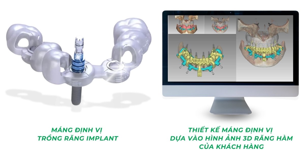 250404 BAI DANG WEB MANG DINH VI CONG NGHE HIEN DAI TRONG TRONG RANG IMPLANT 1080 x 1350 px 2