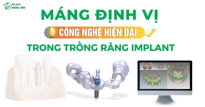 250404 BAI DANG WEB MANG DINH VI CONG NGHE HIEN DAI TRONG TRONG RANG IMPLANT 1080 x 1350 px