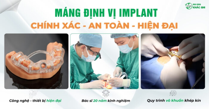 250404 BAI DANG WEB TRONG RANG IMPLANT BANG MANG DINH VI HIEN DAI AN TOAN