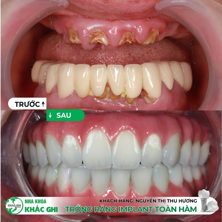HANH TRINH TRONG 12 TRU IMPLANT BANG MANG DINH VI 3D 2