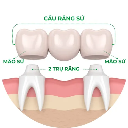 Cầu răng sứ là gì?