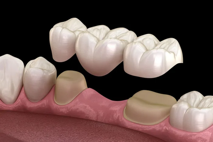 Phương pháp làm cầu răng sứ- Dental Bridges