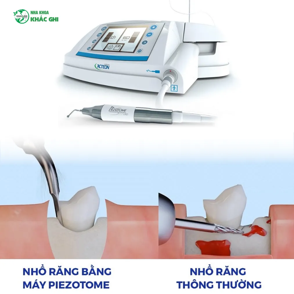 nhổ răng khôn bằng máy siêu âm Piezotome 