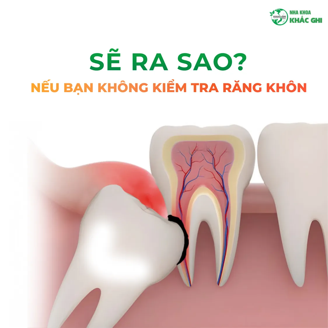 Kiểm tra răng khôn