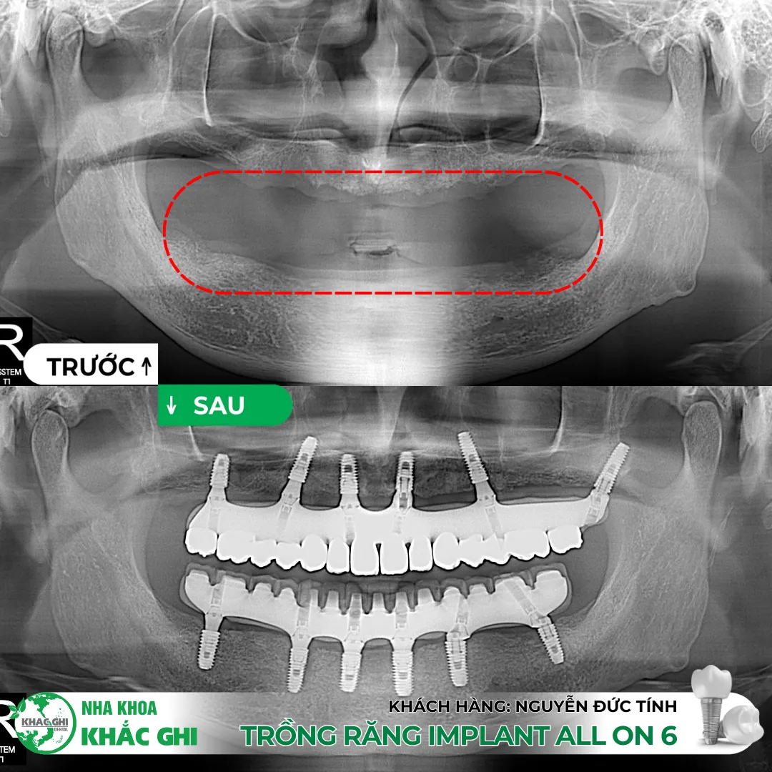 Vì sao nên trồng răng Implant bằng máng định vị 3D (Surgical Guide)? 💚 21 Trồng răng Implant bằng máng định vị 3D (Surgical Guide)