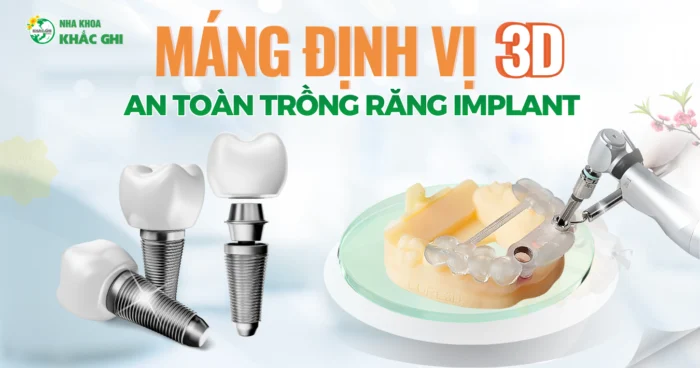 Trồng răng Implant bằng máng định vị 3D (Surgical Guide)