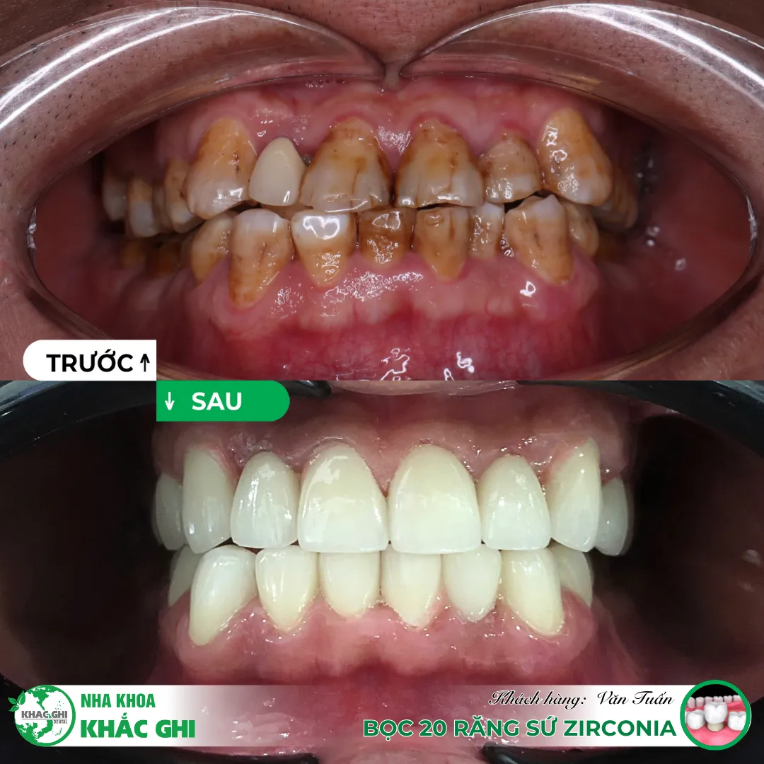 dán sứ thẩm mỹ tự nhiên