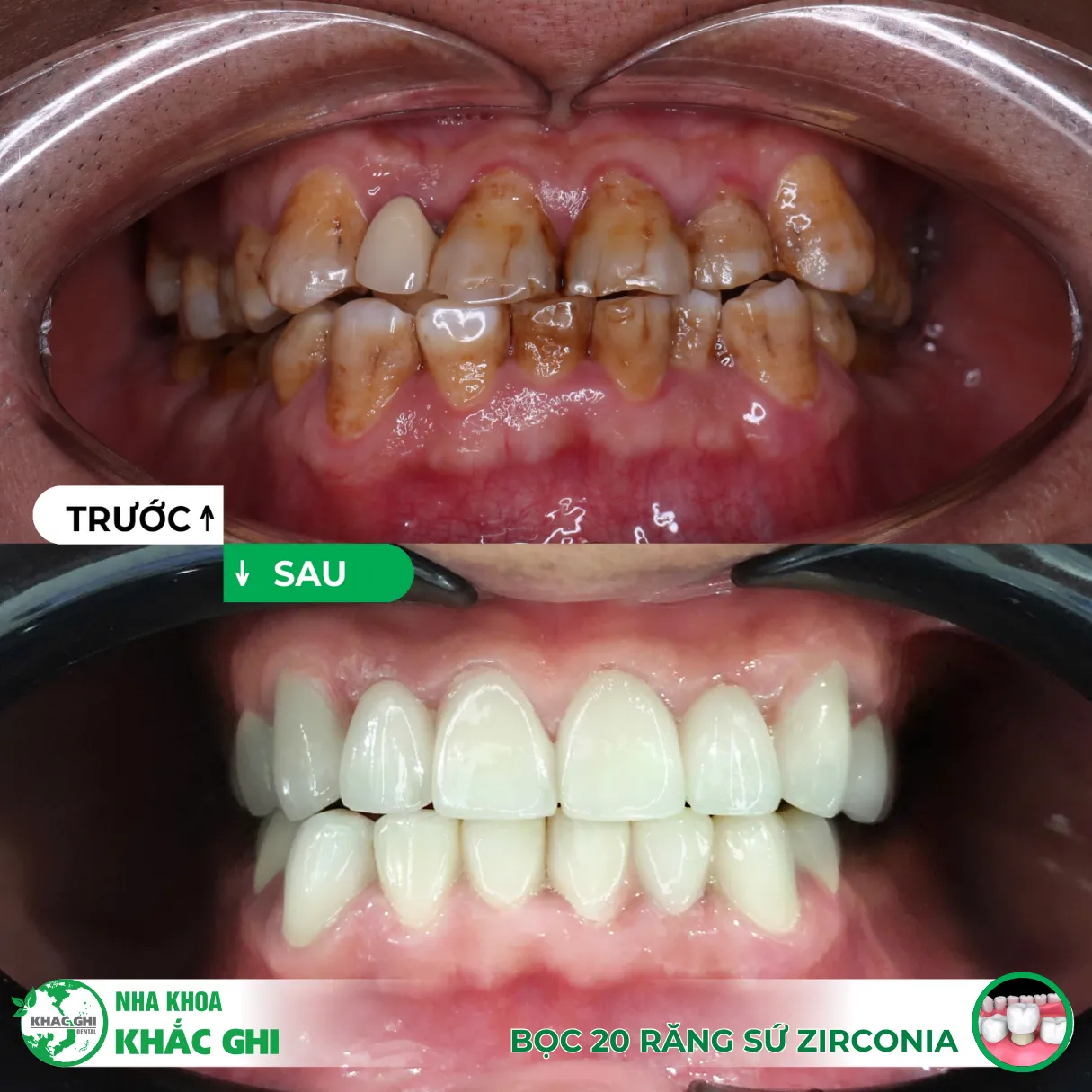 8/3 – Tự thưởng cho bản thân một nụ cười sáng tự nhiên 8 răng sứ thẩm mỹ 8/3