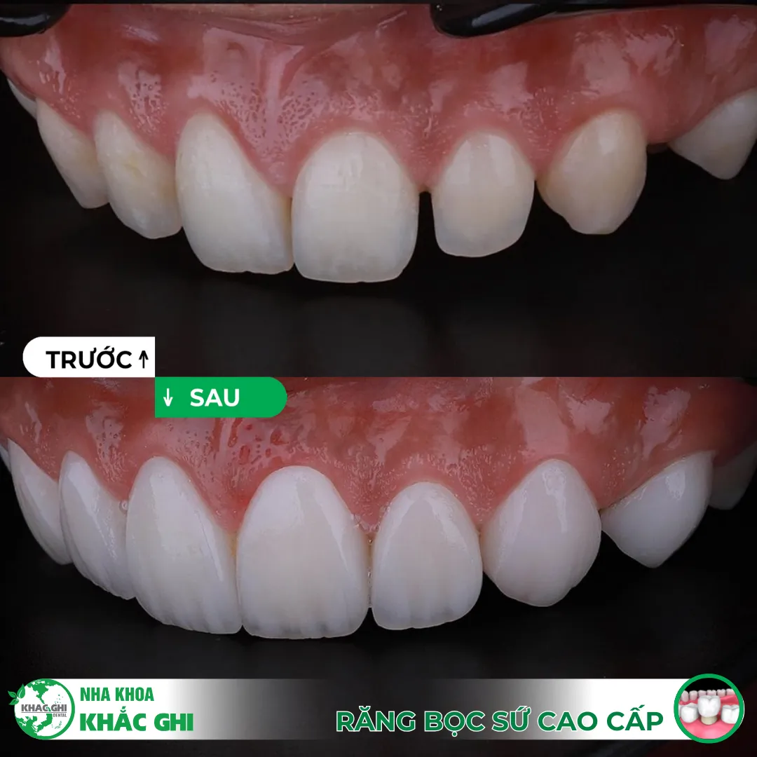 Răng sứ thẩm mỹ Biên Hòa: Răng sáng – Cười xinh – Tự tin đón Tết 10 răng sứ thẩm mỹ