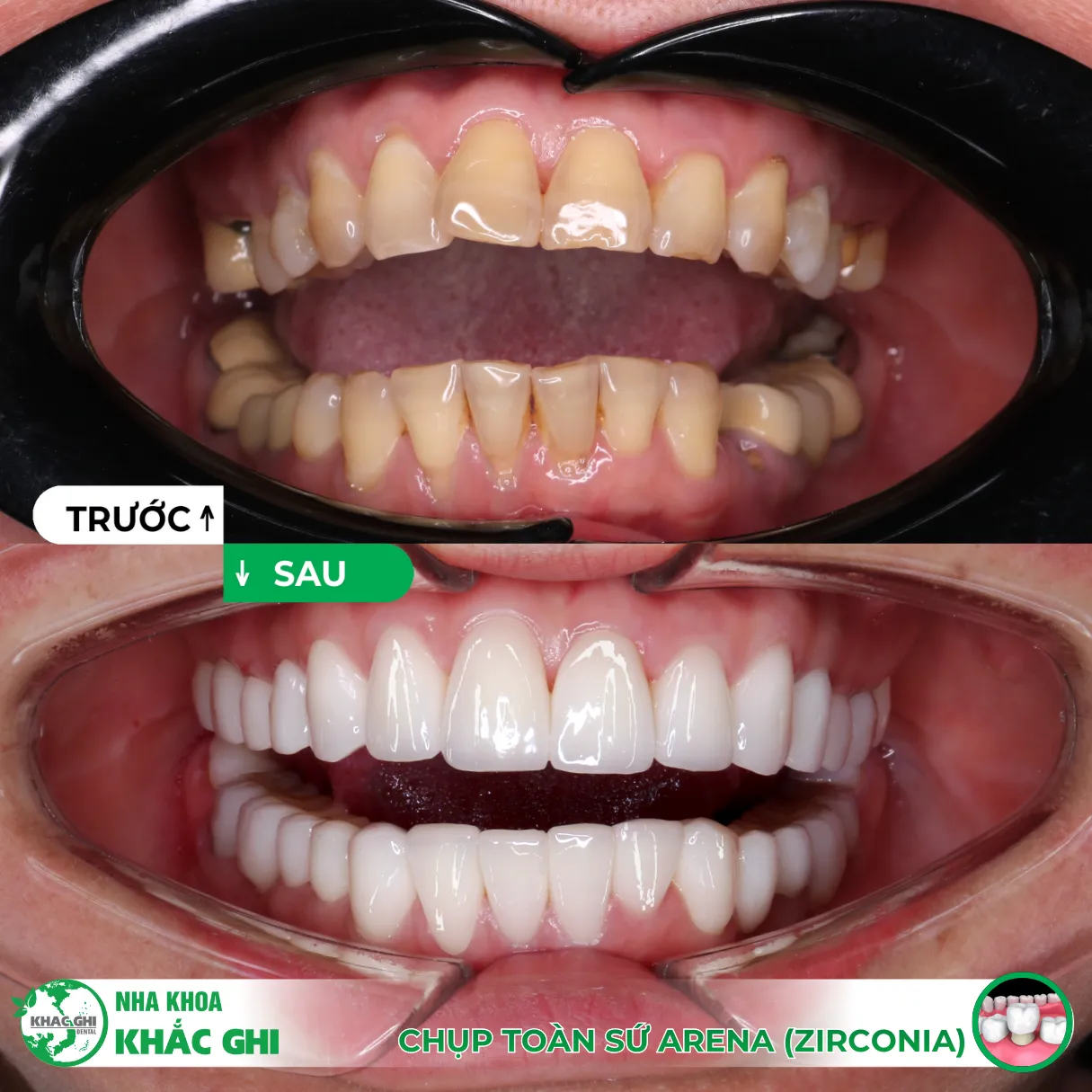 8/3 – Tự thưởng cho bản thân một nụ cười sáng tự nhiên 7 răng sứ thẩm mỹ 8/3