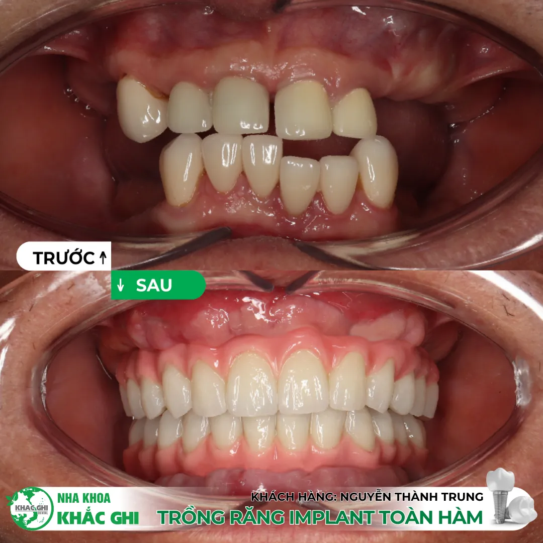 Vì sao nên trồng răng Implant bằng máng định vị 3D (Surgical Guide)? 💚 22 Trồng răng Implant bằng máng định vị 3D (Surgical Guide)
