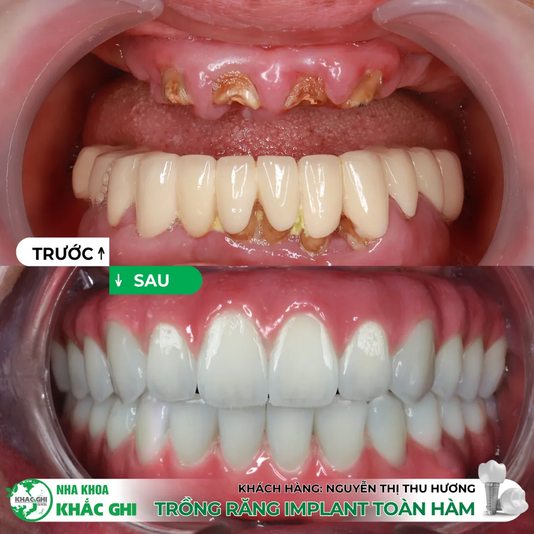 Vì sao nên trồng răng Implant bằng máng định vị 3D (Surgical Guide)? 💚 19 Trồng răng Implant bằng máng định vị 3D (Surgical Guide)
