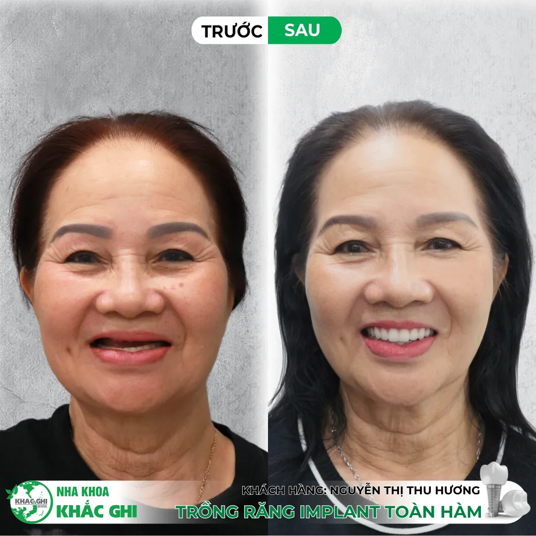 Vì sao nên trồng răng Implant bằng máng định vị 3D (Surgical Guide)? 💚 20 Trồng răng Implant bằng máng định vị 3D (Surgical Guide)