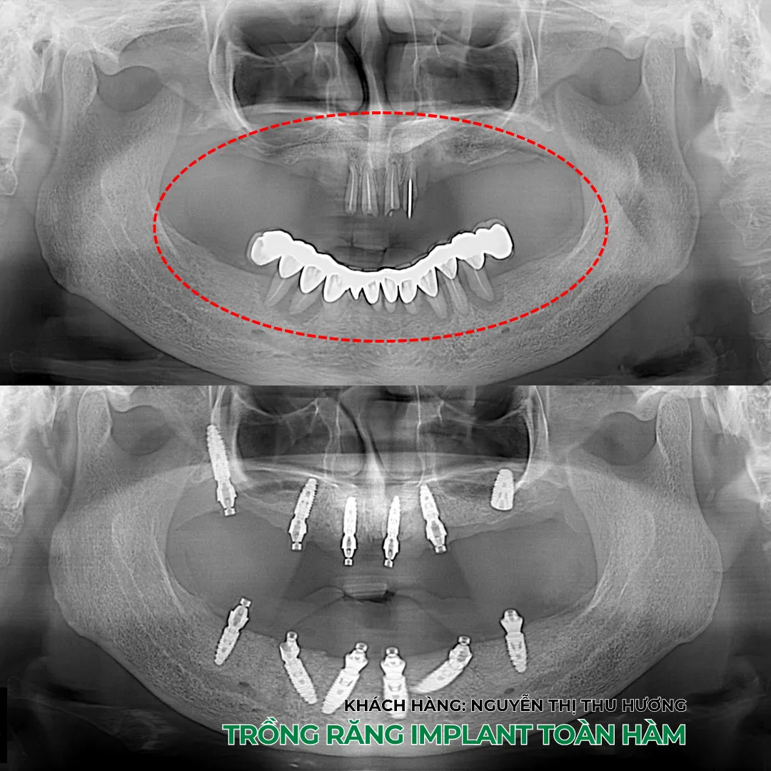 Vì sao nên trồng răng Implant bằng máng định vị 3D (Surgical Guide)? 💚 18 Trồng răng Implant bằng máng định vị 3D (Surgical Guide)