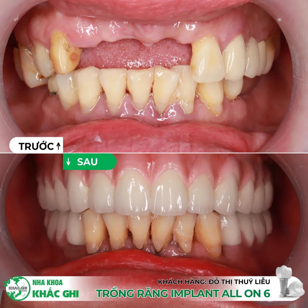 Vì sao nên trồng răng Implant bằng máng định vị 3D (Surgical Guide)? 💚 23 Trồng răng Implant bằng máng định vị 3D (Surgical Guide)