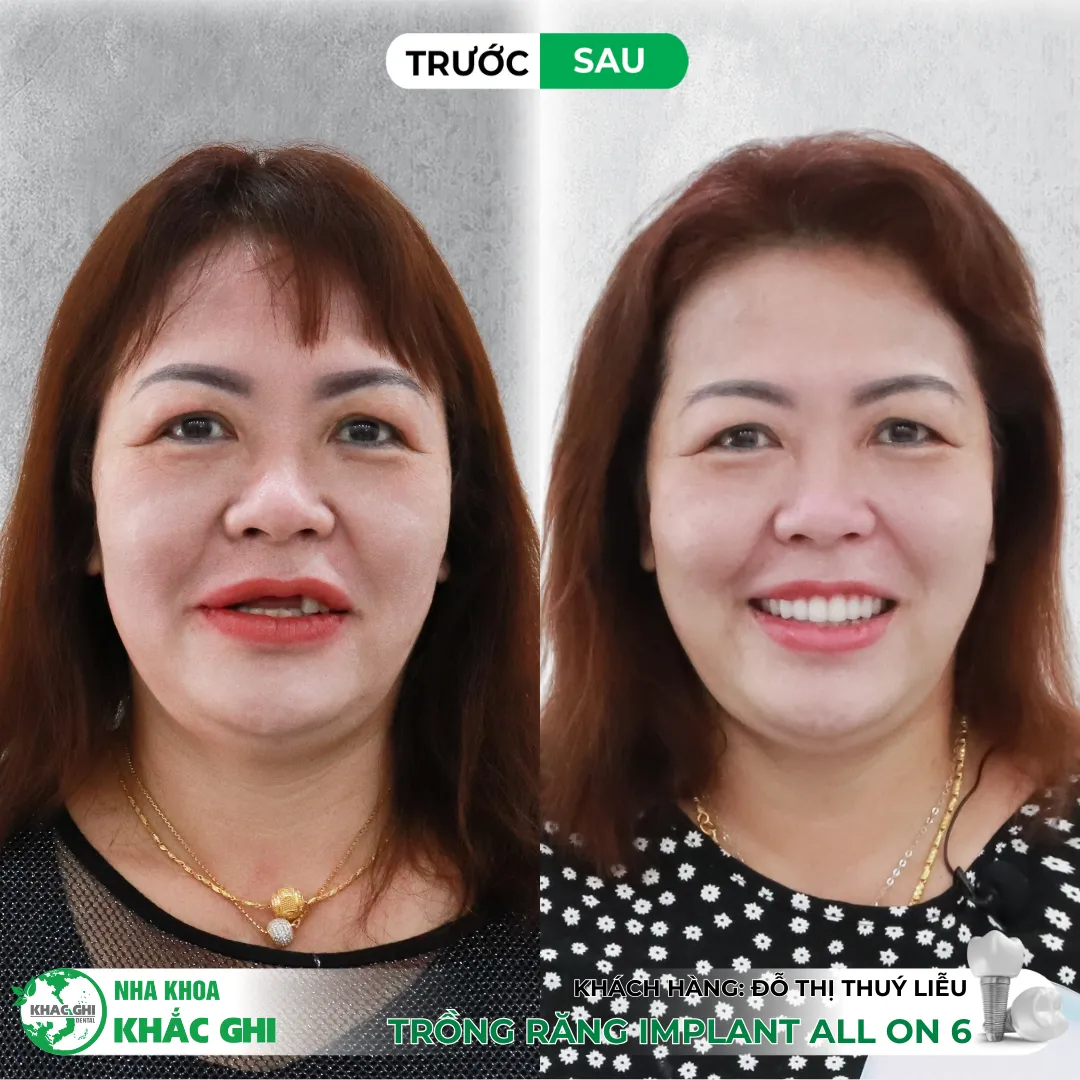 Vì sao nên trồng răng Implant bằng máng định vị 3D (Surgical Guide)? 💚 24 THUY LIEU CHAN DUNG TOAN HAM DA PHUC HINH