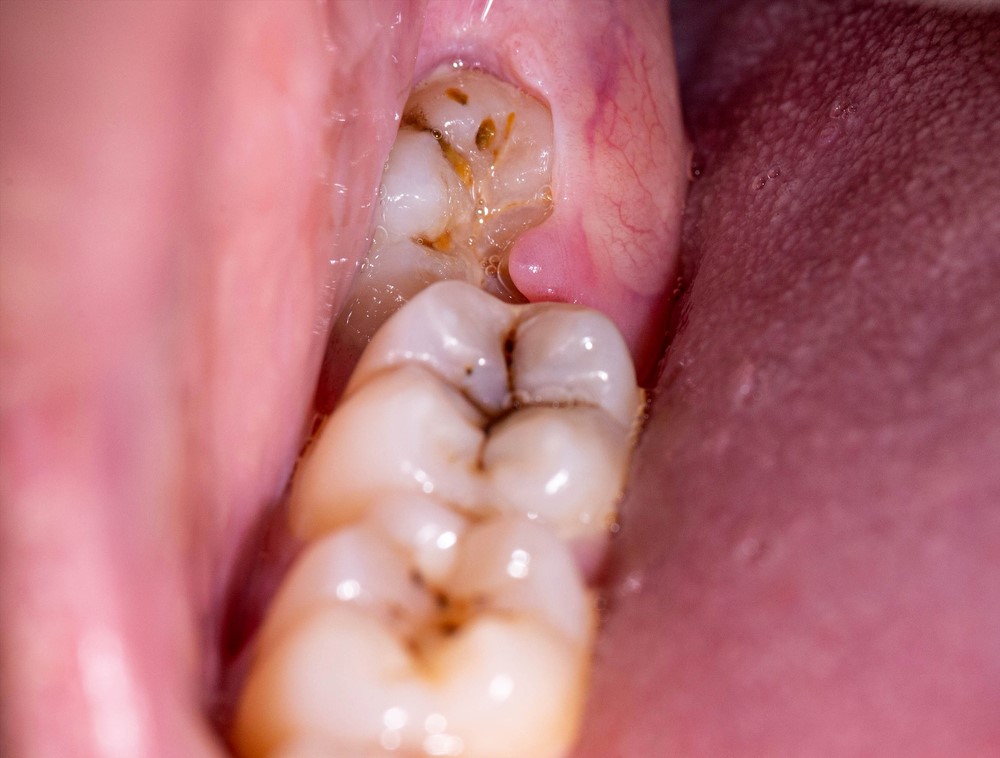 Răng khôn mọc lệch