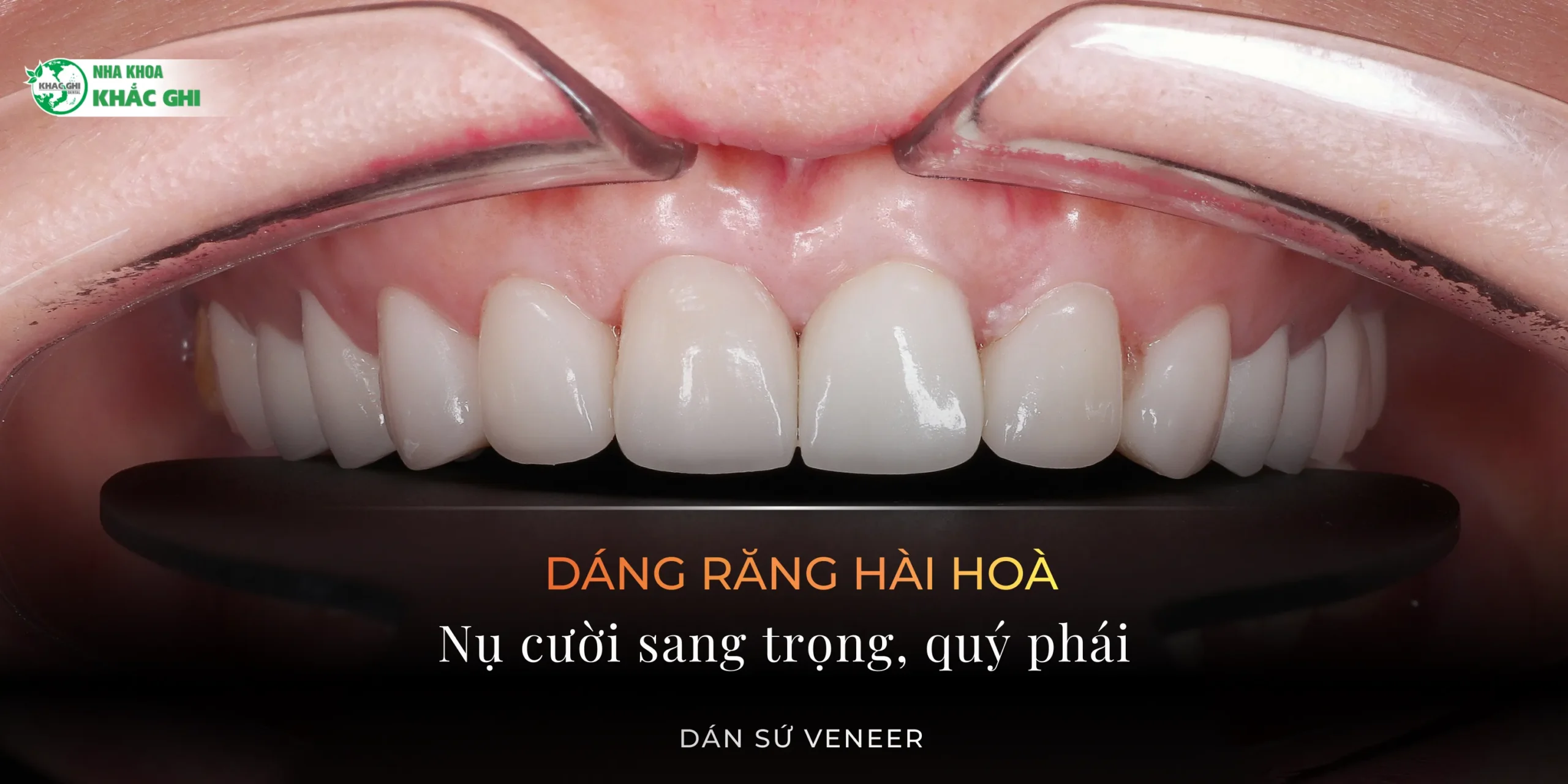 8/3 – Tự thưởng cho bản thân một nụ cười sáng tự nhiên 9 Dán sứ veneer