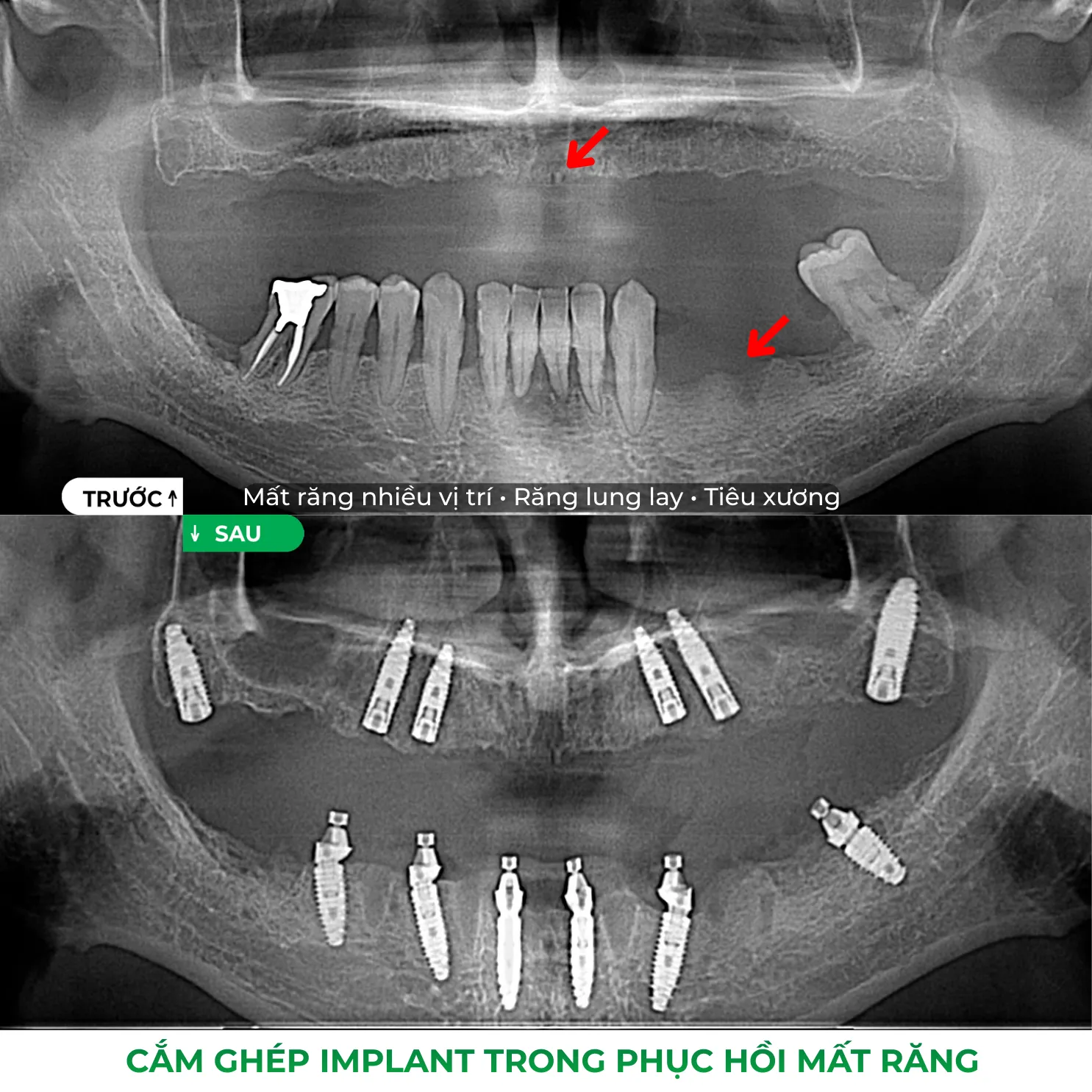 mất răng lâu năm