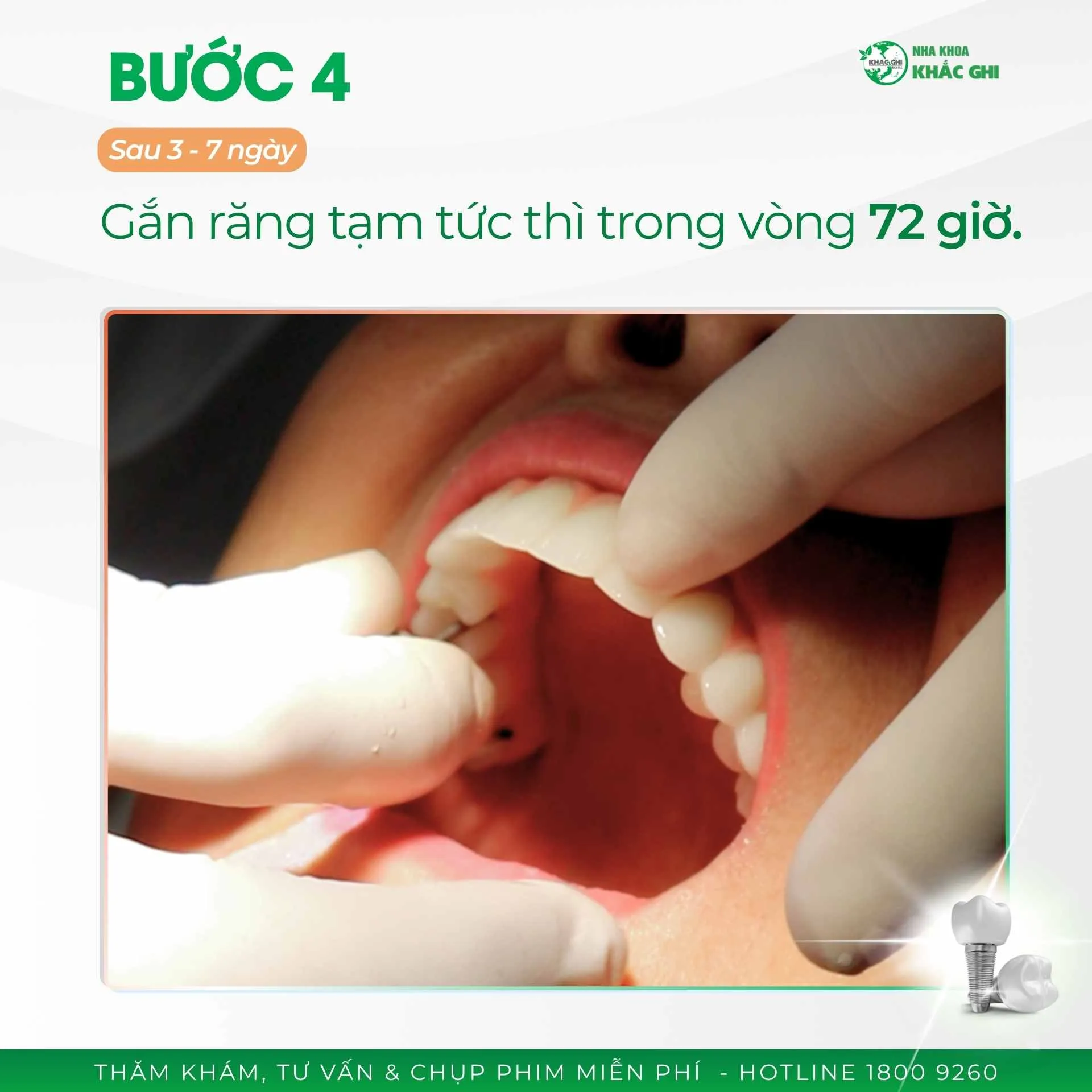 Quy trình phục hình sứ toàn hàm cố định trên Implant diễn ra như thế nào? 42 250507 CSKH QUY TRINH CAY GHEP IMPLANT TOAN HAM 5