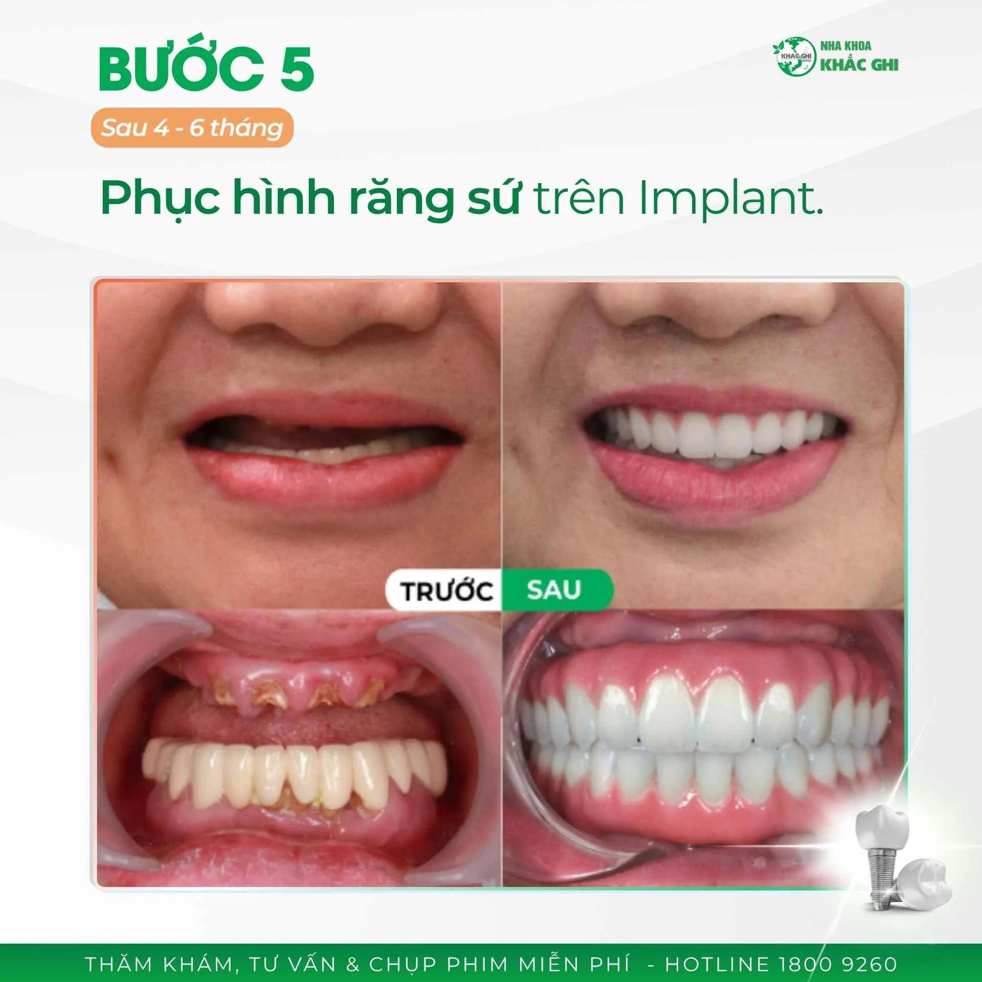 Quy trình phục hình sứ toàn hàm cố định trên Implant diễn ra như thế nào? 43 250507 CSKH QUY TRINH CAY GHEP IMPLANT TOAN HAM 6